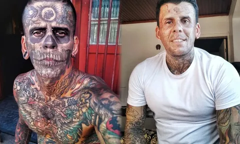 Quá trình xóa xăm đau đớn của người đàn ông 'phủ mực' 95% cơ thể