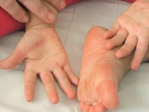 Ghi nhận gần 9.000 ca tay chân miệng, 3 người tử vong: Bộ Y tế chỉ đạo khẩn