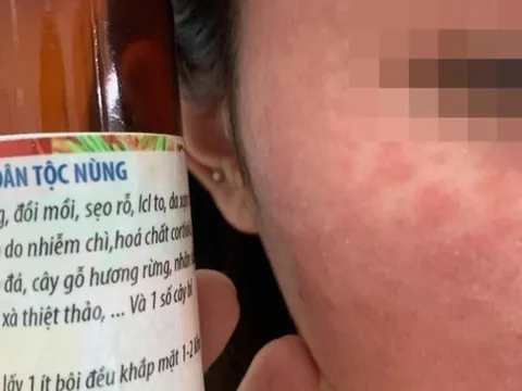 Hà Nội: Mê "lột da" làm đẹp, thiếu nữ nhận lại làn da rắn