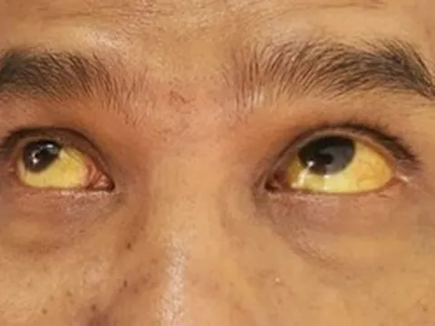 Căn bệnh có tỷ lệ nhiễm cao ở Việt Nam, nhiều người nhầm lẫn tai hại