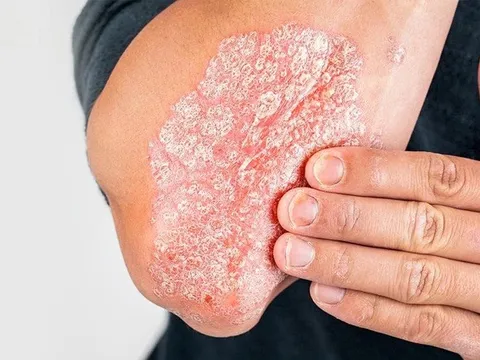 Tự điều trị bệnh da, người đàn ông nằm cáng vì tổn thương khớp nghiêm trọng