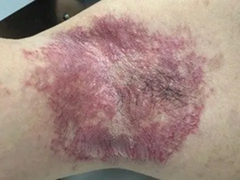 Bác sĩ Việt Nam chữa khỏi bệnh da di truyền hiếm gặp nhờ tiêm botox