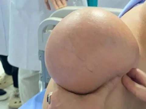Người đàn ông "gánh" khối u khổng lồ trên vai suốt 5 năm