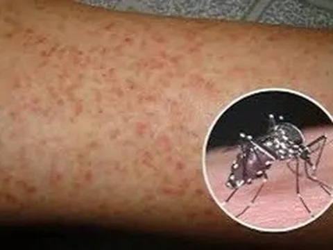 Đồng Tháp: Sốt xuất huyết tăng 4-5 lần, cảnh báo biến chứng nặng