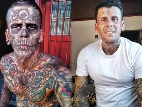 Quá trình xóa xăm đau đớn của người đàn ông 'phủ mực' 95% cơ thể