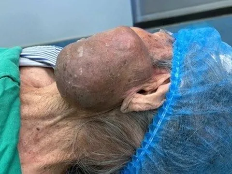 Cắt bỏ khối u khổng lồ trên mặt bệnh nhân 99 tuổi