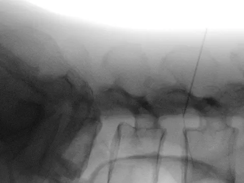 Dị vật 6cm “mắc kẹt” trong thắt lưng vì tự châm cứu