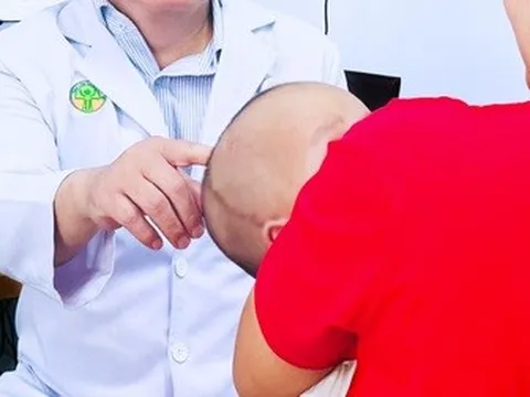 Căn bệnh khiến bé trai ở TPHCM bỗng méo đầu sau sinh, phải mổ sọ não