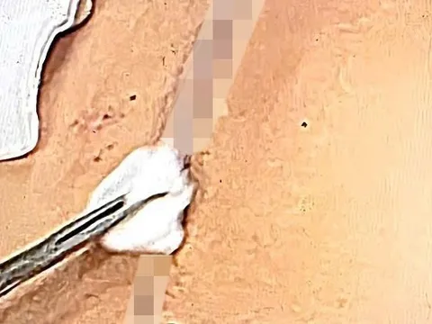 Chuyện kỳ lạ giữa lằn ranh sống - chết - Kỳ 9: 10 giờ chiến đấu với tử thần trên bàn mổ