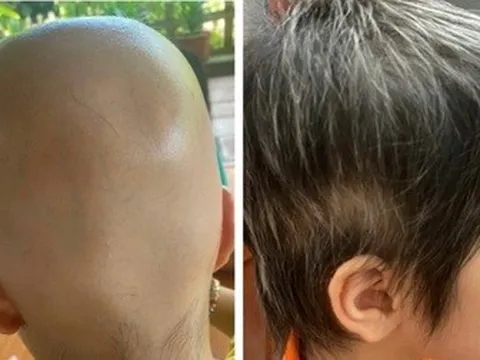 Nhiều người trẻ bỗng dưng rụng tóc trơ trọi