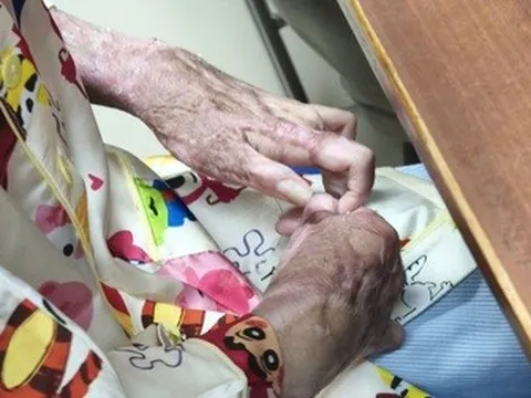 Thiếu nữ 17 tuổi bị bạn đốt keo nến làm cháy khắp người, phải mổ 15 lần