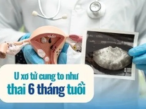 Tưởng béo bụng, người phụ nữ mang khối u như thai 6 tháng suốt nhiều năm