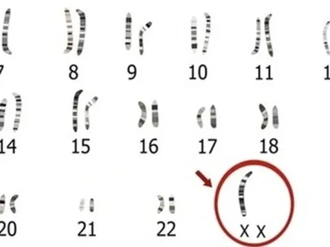 Kỳ lạ, cô gái 24 tuổi vẫn chưa dậy thì vì "lỗi ngẫu nhiên" của cơ thể