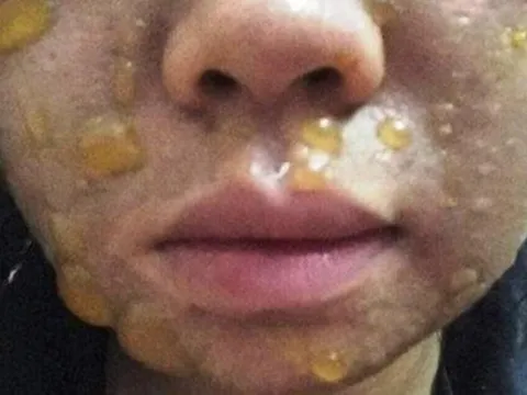 Nhiều người nhập viện vì mặt sưng húp, sạm đen sau peel da theo mạng xã hội
