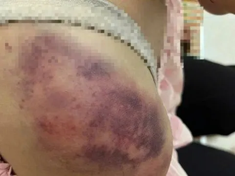 Bé gái 12 tuổi nghi bị bà nội hành hạ, may mắn không gãy xương