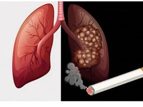 90% người bệnh mắc loại ung thư gây tử vong hàng đầu liên quan đến thuốc lá