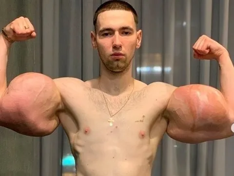 'Quái vật phòng gym' Nga trả giá đắt vì cặp bắp tay 61 cm