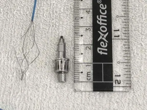 Mất dụng cụ khi làm răng, 2 tuần sau mới phát hiện trong phế quản bệnh nhân