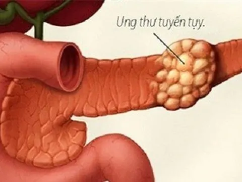 Nhiều tiến bộ trong điều trị căn bệnh ung thư ác tính hàng đầu