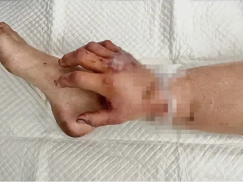 Thai phụ được ghép tạm tay đứt lìa vào chân đã thực hiện ca mổ "định mệnh"