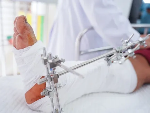 TPHCM: Nhiều người gặp tai nạn đứt lìa chi, bàn chân bị nghiền nát