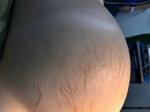 TPHCM: Cô gái che giấu bụng to vì sợ hiểu lầm, khối ung thư phát triển 15kg