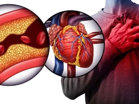 Nguy cơ đột tử vì nhồi máu cơ tim, cần làm gì khi mang gene dễ mắc bệnh?