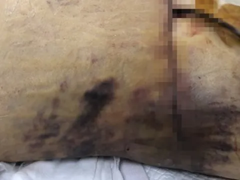 Nữ Việt kiều 60 tuổi tử vong vì biến chứng nặng sau khi hút mỡ, nâng ngực