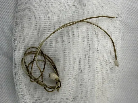 Gắp dây sạc trong bàng quang nam sinh 16 tuổi