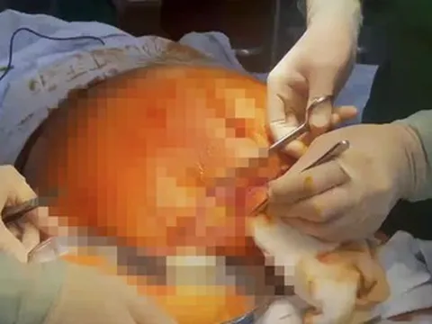 Người phụ nữ thủng ruột nguy kịch sau hút mỡ, 81 ngày chống chọi tử thần