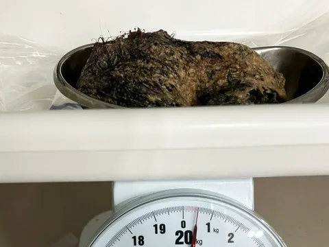 Bé gái 6 tuổi ăn nửa cân tóc