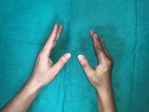 Lần đầu tiên tại Việt Nam, ngón tay đứt rời 25 giờ được nối thành công