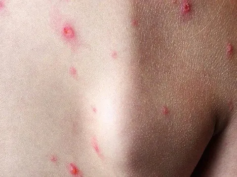 Một tỉnh phía Nam ghi nhận ca mắc đậu mùa khỉ đầu tiên