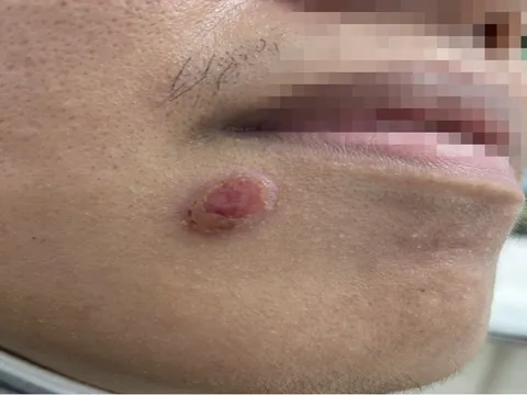 TPHCM: Nhiều chàng trai nhiễm bệnh hiểm sau quan hệ với bạn tình đồng giới