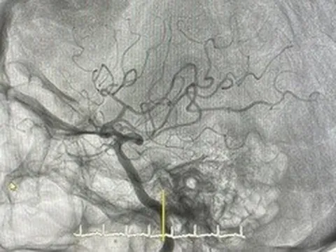 Cục máu đông khiến cụ bà suýt mất hàng triệu tế bào não mỗi phút