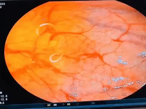 Món nhiều người mê đưa ổ giun vào bụng người phụ nữ