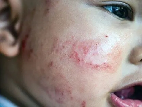 Lý do ngày càng nhiều trẻ em bị viêm da cơ địa, dị ứng thức ăn...