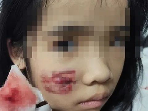Bị khỉ hoang tấn công, bé gái nhập viện với nhiều vết thương ở mặt và đầu