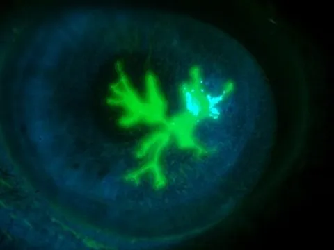 Người phụ nữ phát hiện "cành cây" ở giác mạc, suýt mù vì thói quen dụi mắt