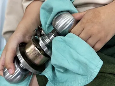 Cấp cứu bé trai 5 tuổi bị kẹt chặt ngón tay vào ổ khóa