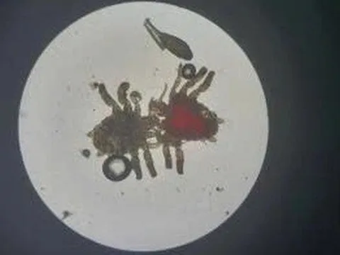 Quý ông tá hỏa phát hiện cả đàn rận "sống nhờ" ở vùng kín