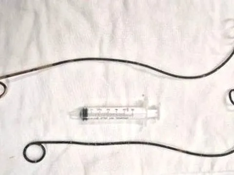 Lấy 2 ống thông điều trị tiết niệu bỏ quên trong người đàn ông hơn 10 năm