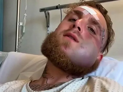 Mặt Jake Paul biến dạng