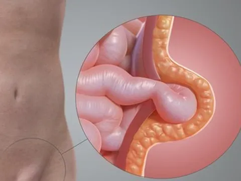 Căn bệnh ở vùng kín khiến người đàn ông suýt hoại tử