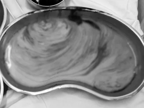 Hút 3 lít dịch mủ ở mông người phụ nữ bị biến chứng nặng sau tiêm filler