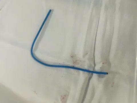 Ống thông truyền hóa chất bị đứt, trôi vào tim khiến người phụ nữ nguy kịch