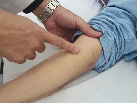 Số ca bệnh do não mô cầu tăng mạnh