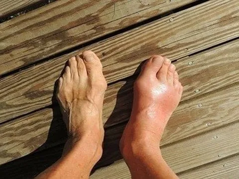 Người bị gout có thể ăn bao nhiêu thịt mỗi ngày?