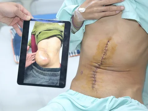 Cứu chàng trai khỏi khối u bụng khổng lồ như quả bóng, vỡ bất cứ lúc nào