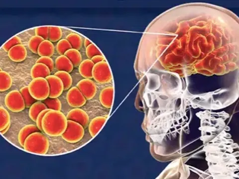 Não mô cầu tăng gấp 6 lần: Dấu hiệu nhận biết